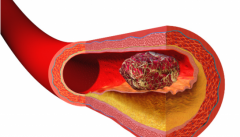 用于CT血管造影的AI系统取得了进展 用于CT血管造影的AI系统取得了进展